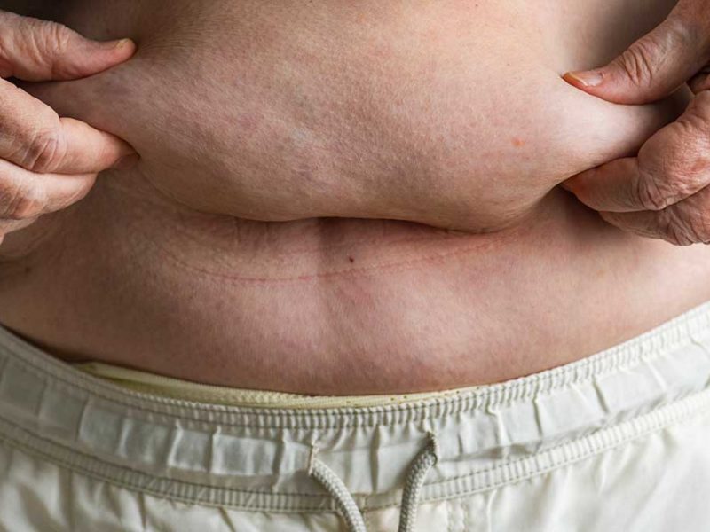 obesità in italia