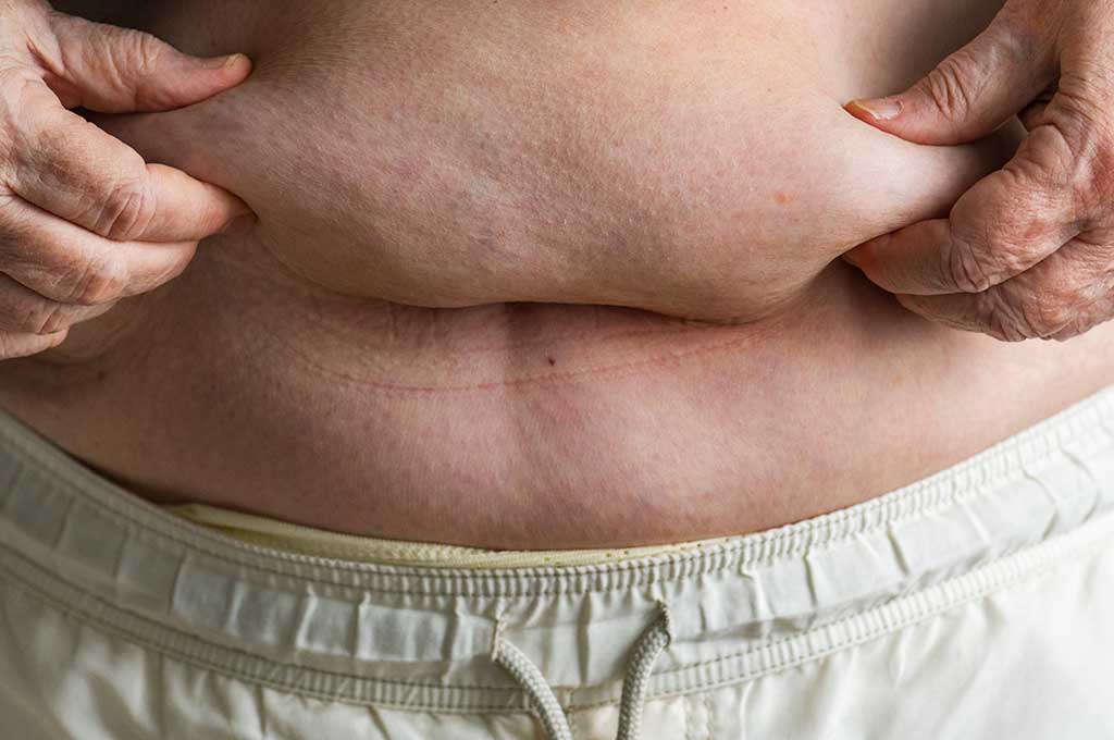 obesità in italia