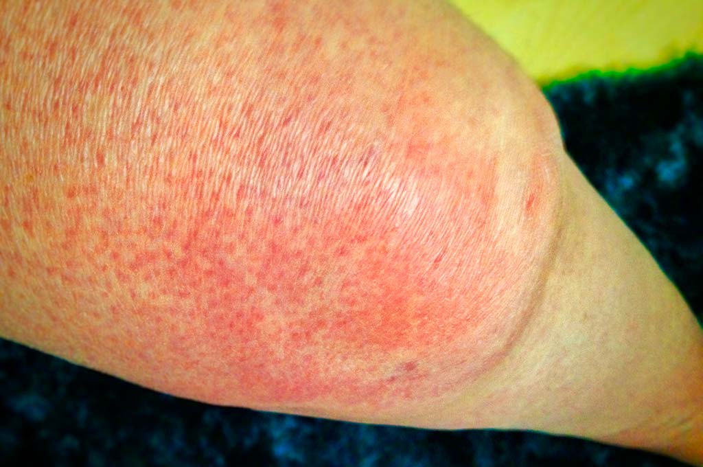 allergie crociate